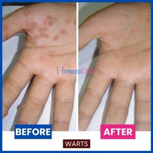 warts palms homeopathic treatment