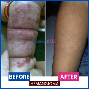 hemangioma hands homeopathic treatment