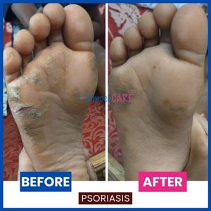planter psoriasis homeopathic treatment