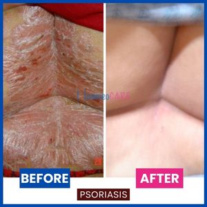 homeopathic treatment psoriasis