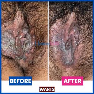homeopathic treatment for genital warts