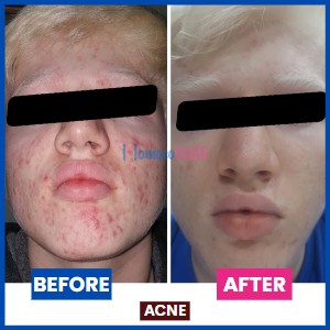 homeopathic treatment for acne rosacea