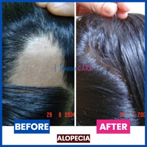 homeopathic treatment for alopecia areata
