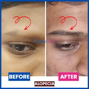 homeopathic treatment for Alopecia on eyebrows