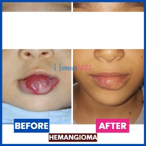 homeopathic treatment for Hemangioma