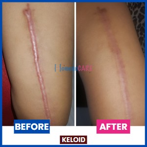 homeopathic treatment for Keloid