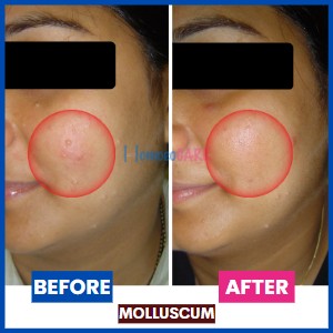 homeopathic treatment for Molluscum on face