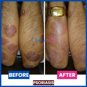 homeopathic treatment for Psoriasis on hands