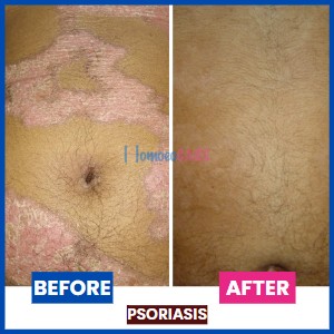 homeopathic treatment for Psoriasis on Stomach