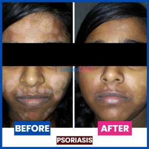 homeopathic treatment for Psoriasis on face