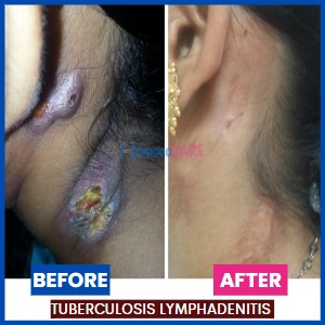 homeopathic treatment for Tuberculosis Lymphadenitis