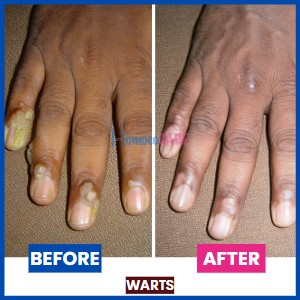 homeopathic treatment for Warts on fingers