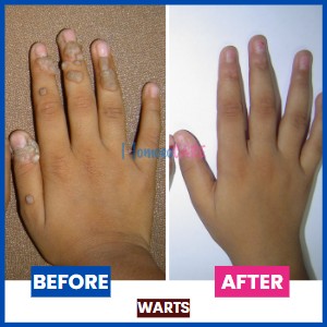 homeopathic treatment for Warts on Hand