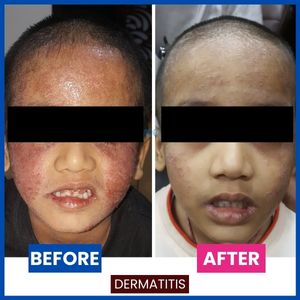 atopic dermatitis treatment for homeopathic