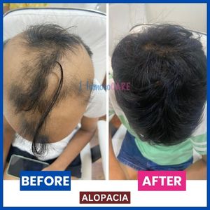  successful homeopathic treatment of Alopecia areata