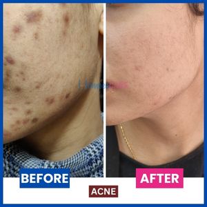  Before and after images illustrating successful homeopathic treatment of pimples.