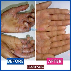 Before and after images showcasing successful homeopathic treatment of psoriasis on a hand.