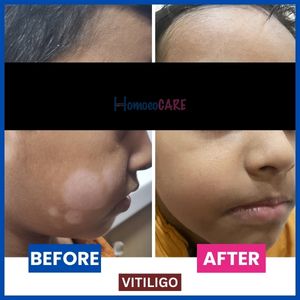 Before and after images showcasing successful homeopathic treatment for vitiligo on the face, with v