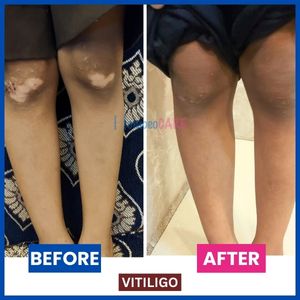 Before-and-after photos show effective homeopathic treatment for vitiligo on the leg, reducing white