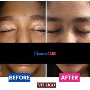 Comparative images depict the success of homeopathic treatment for vitiligo, demonstrating a visible