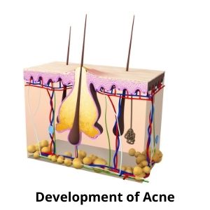 What are the causes of Acne?