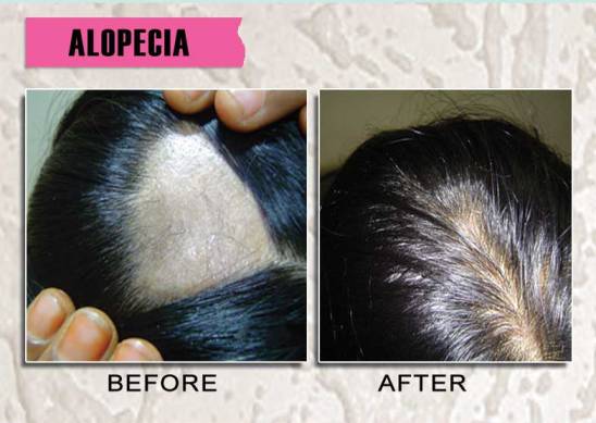 Is Alopecia Areata Permanent