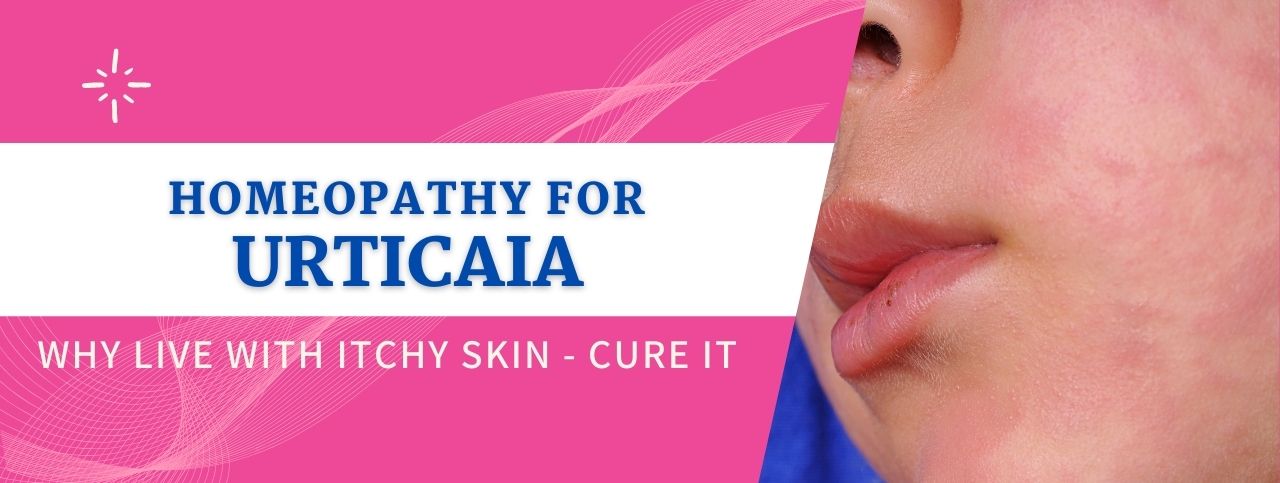 homeopathy for urticaria