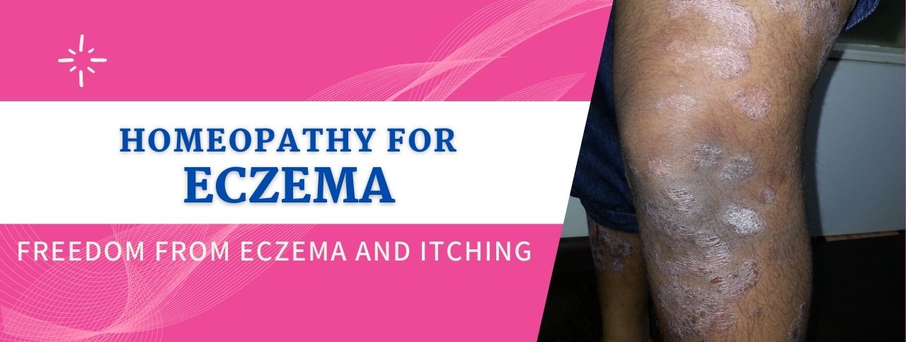 successful Homeopathic Treatment for Eczema