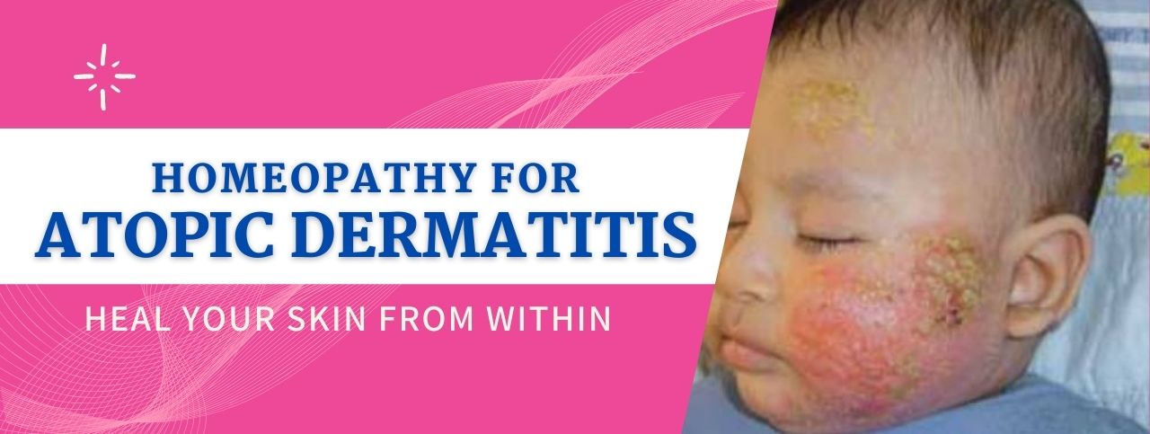 Atopic Dermatitis for face