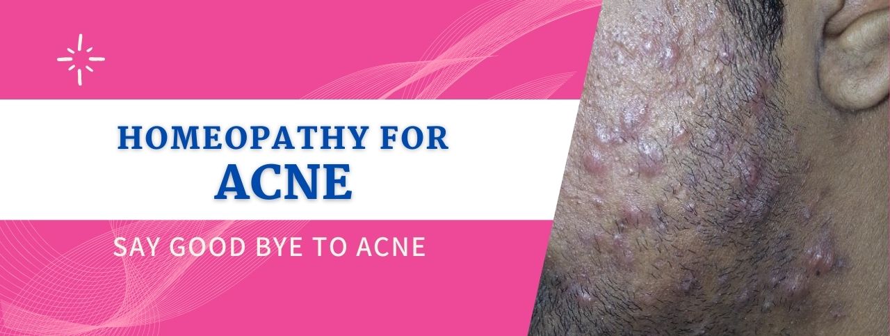 Homoeopathic Treatment for Acne