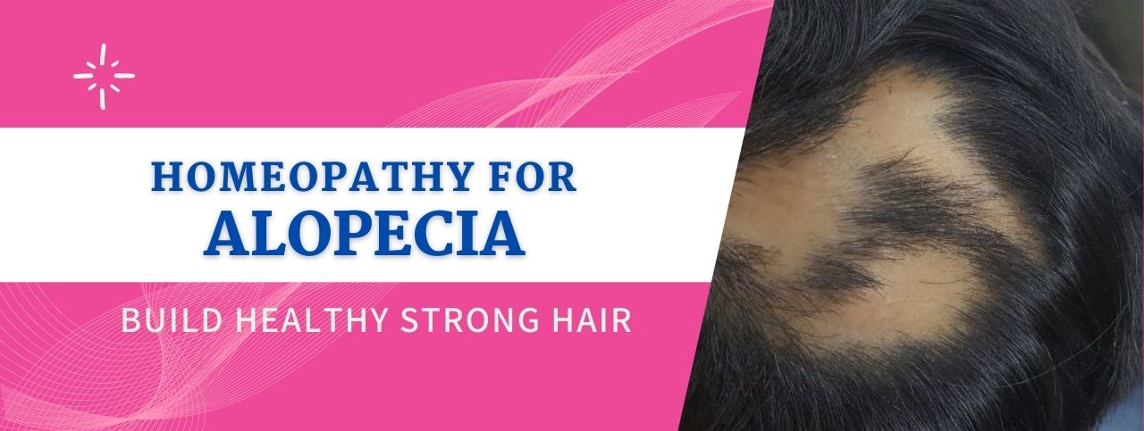 Homeopathic Treatment for Alopecia Areata | HomoeoCARE