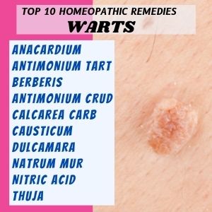 Top 10 Homeopathic medicines for Warts
