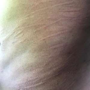 Conventional for Urticaria treatment 