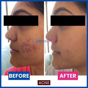 Acne can be classified according to the severity