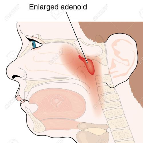 Adenoids